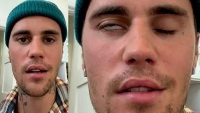 Photo of Justin Bieber Has Facial Paralysis, Reveals Ramsay Hunt Syndrome Diagnosis in Video Message